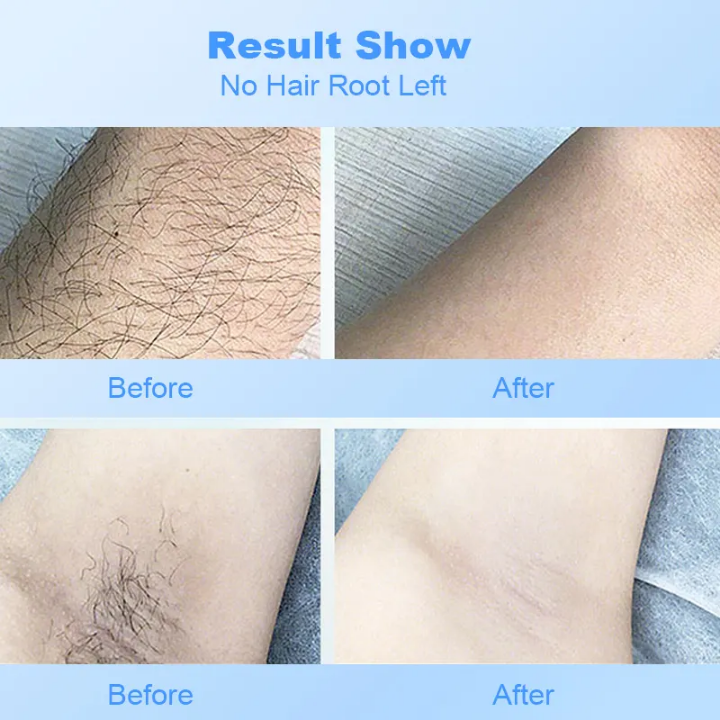 IPL Laser Hair Removal Machine